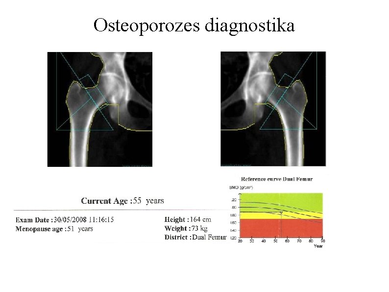 Osteoporozes diagnostika 