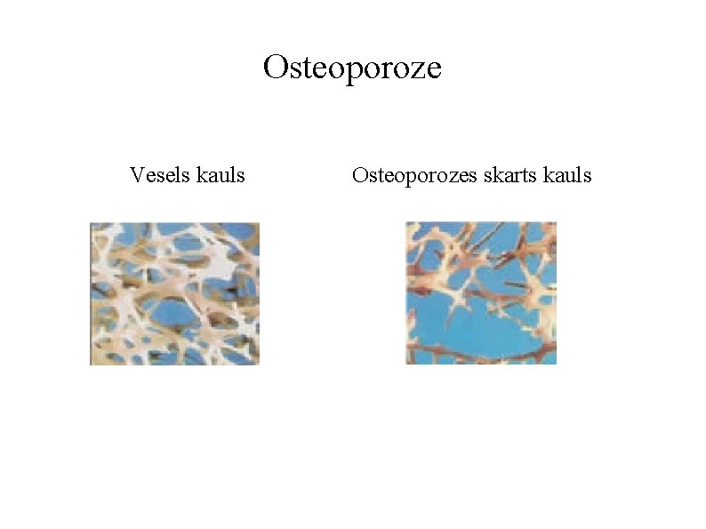 Osteoporoze Vesels kauls Osteoporozes skarts kauls 