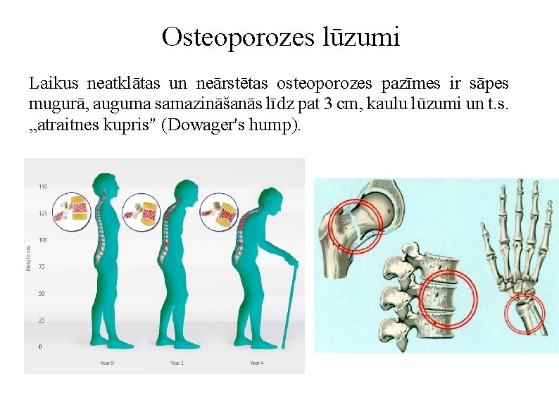 Osteoporozes lūzumi Laikus neatklātas un neārstētas osteoporozes pazīmes ir sāpes mugurā, auguma samazināšanās līdz