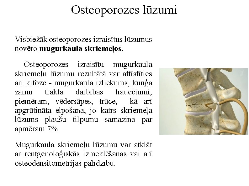 Osteoporozes lūzumi Visbiežāk osteoporozes izraisītus lūzumus novēro mugurkaula skriemeļos. Osteoporozes izraisītu mugurkaula skriemeļu lūzumu