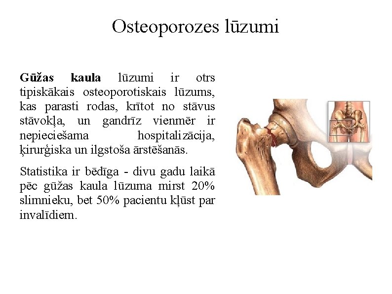 Osteoporozes lūzumi Gūžas kaula lūzumi ir otrs tipiskākais osteoporotiskais lūzums, kas parasti rodas, krītot