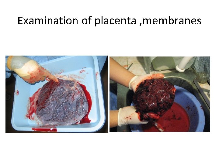 Examination of placenta , membranes 