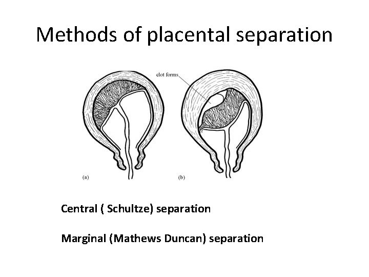 Methods of placental separation Central ( Schultze) separation Marginal (Mathews Duncan) separation 