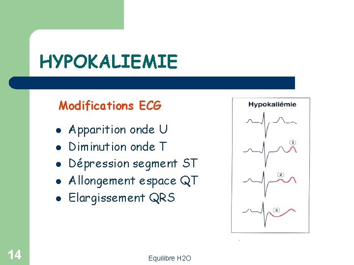 HYPOKALIEMIE Modifications ECG l l l 14 Apparition onde U Diminution onde T Dépression