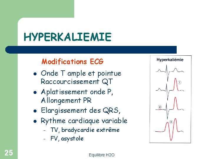 HYPERKALIEMIE Modifications ECG l l Onde T ample et pointue Raccourcissement QT Aplatissement onde