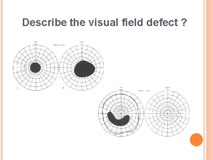Describe the visual field defect ? 