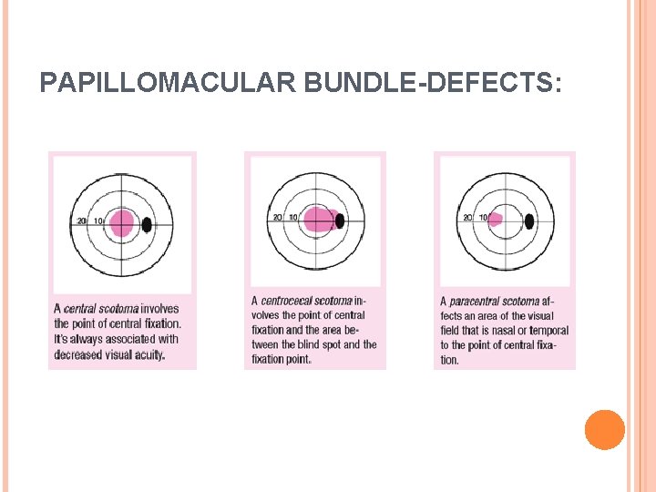 PAPILLOMACULAR BUNDLE-DEFECTS: 