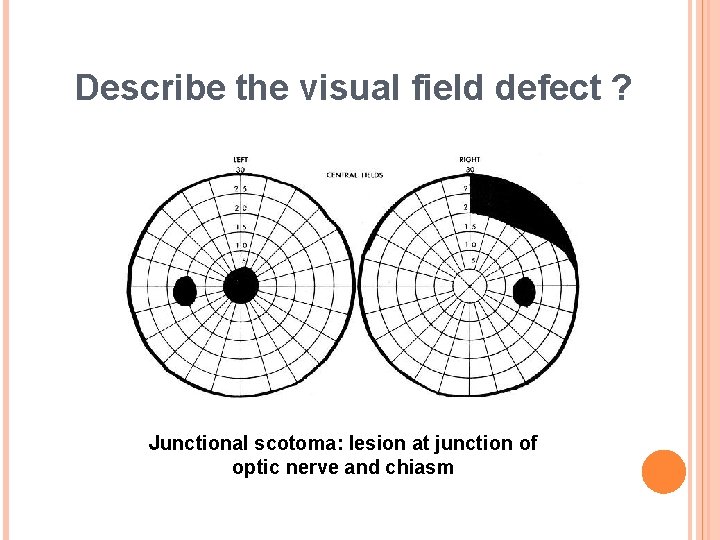 Describe the visual field defect ? Junctional scotoma: lesion at junction of optic nerve