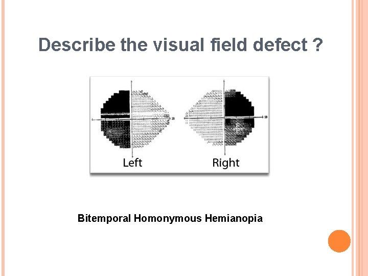 Describe the visual field defect ? Bitemporal Homonymous Hemianopia 