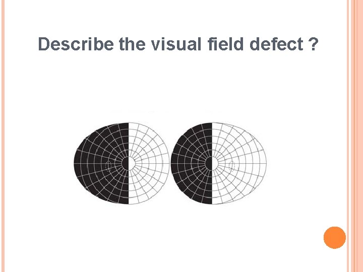 Describe the visual field defect ? 