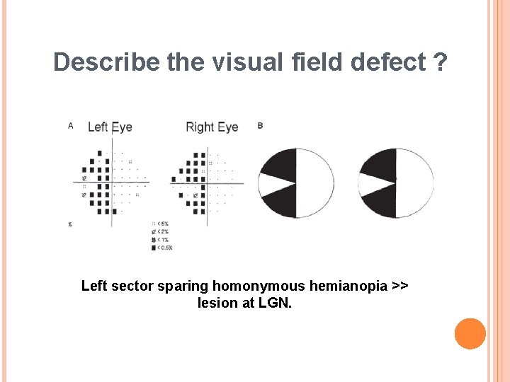 Describe the visual field defect ? Left sector sparing homonymous hemianopia >> lesion at