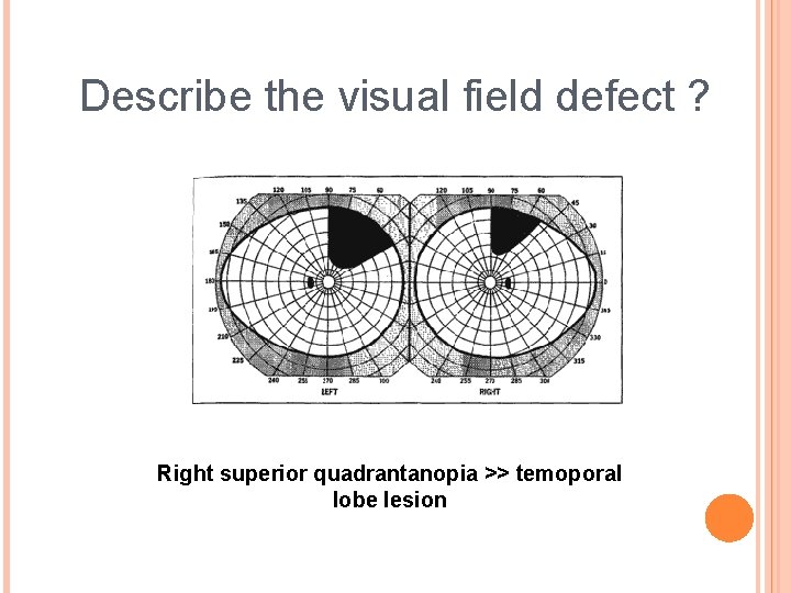 Describe the visual field defect ? Right superior quadrantanopia >> temoporal lobe lesion 