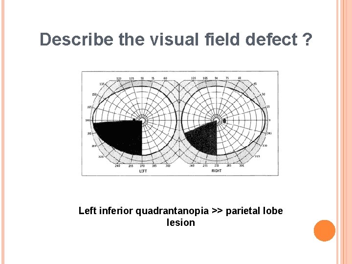 Describe the visual field defect ? Left inferior quadrantanopia >> parietal lobe lesion 