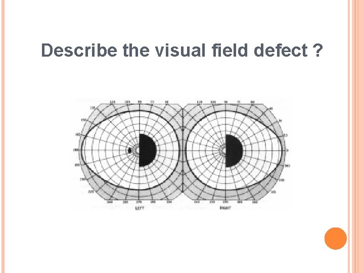 Describe the visual field defect ? 