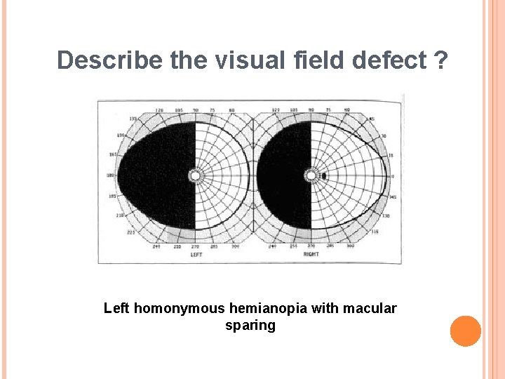 Describe the visual field defect ? Left homonymous hemianopia with macular sparing 