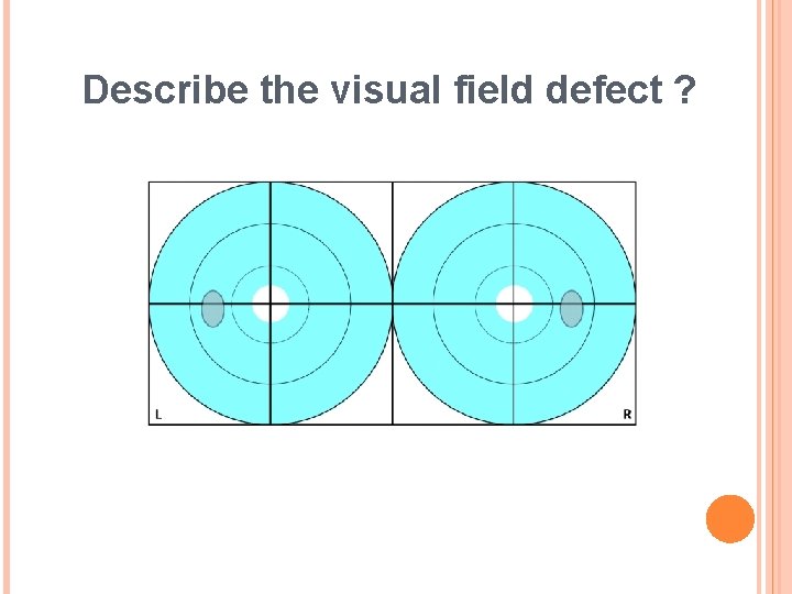 Describe the visual field defect ? 