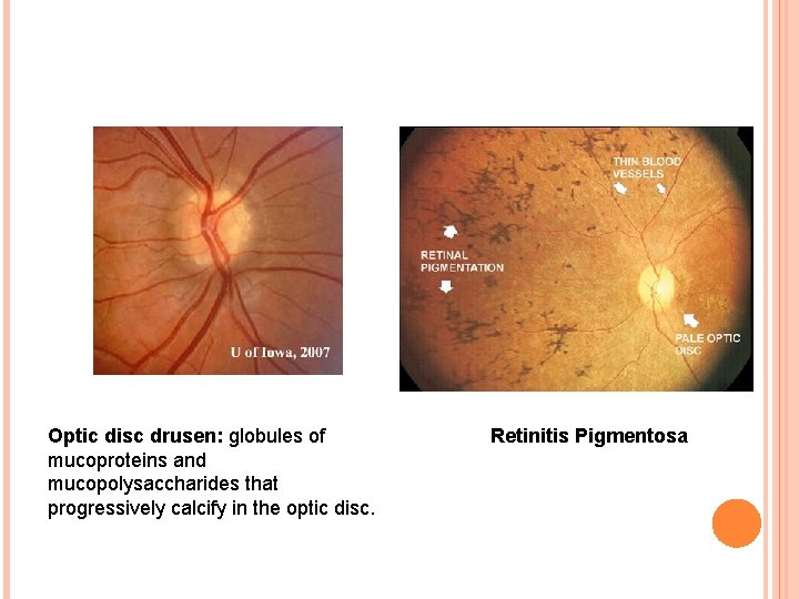 Optic disc drusen: globules of mucoproteins and mucopolysaccharides that progressively calcify in the optic