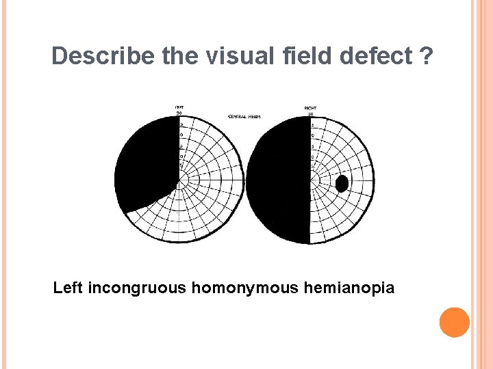 Describe the visual field defect ? Left incongruous homonymous hemianopia 