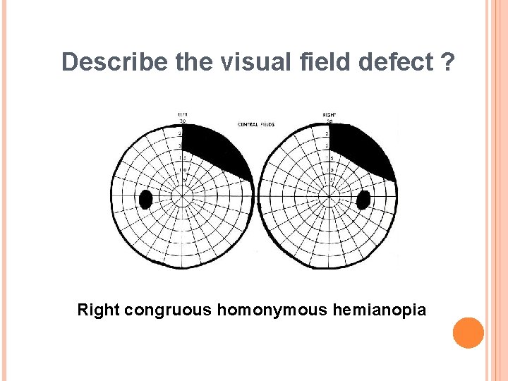 Describe the visual field defect ? Right congruous homonymous hemianopia 