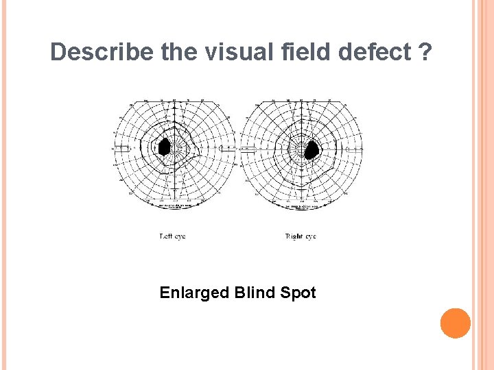 Describe the visual field defect ? Enlarged Blind Spot 