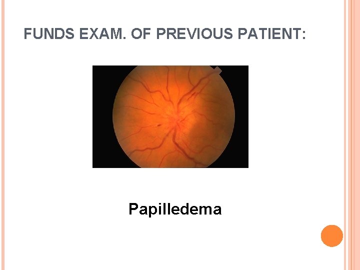 FUNDS EXAM. OF PREVIOUS PATIENT: Papilledema 