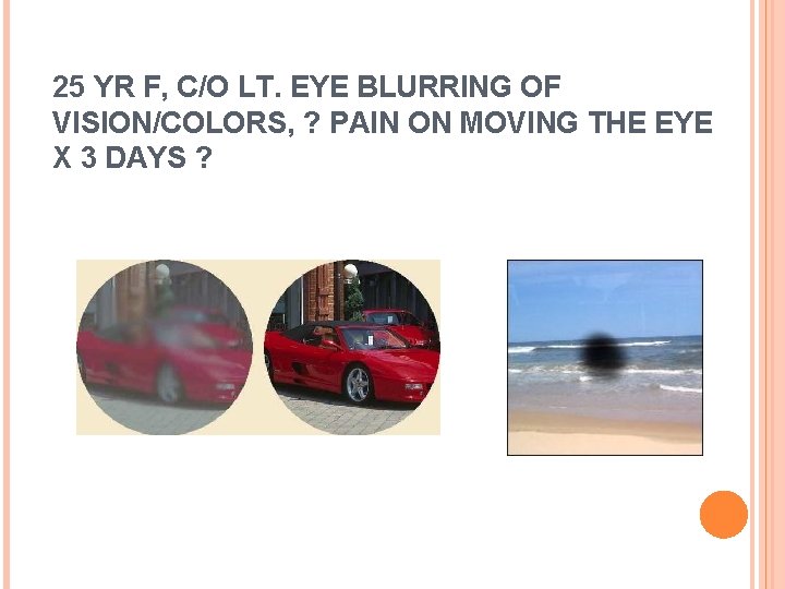 25 YR F, C/O LT. EYE BLURRING OF VISION/COLORS, ? PAIN ON MOVING THE