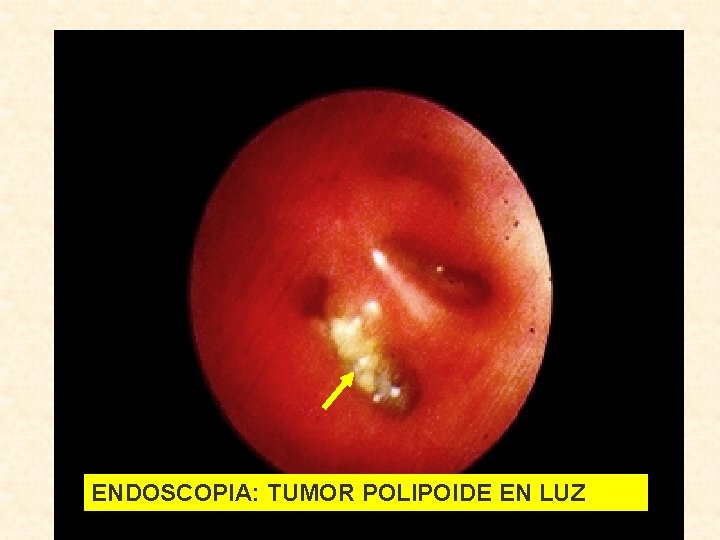  ENDOSCOPIA: TUMOR POLIPOIDE EN LUZ 