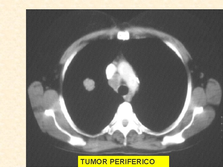  TUMOR PERIFERICO 
