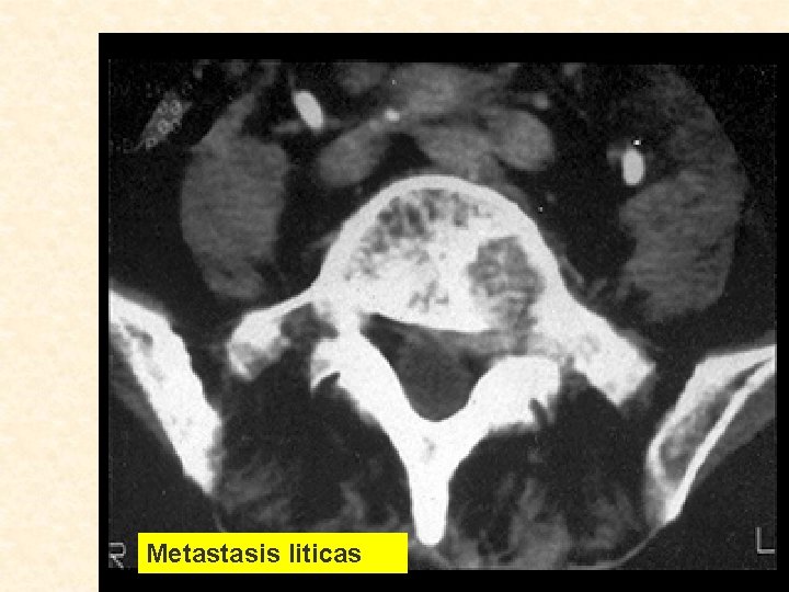  Metastasis liticas 