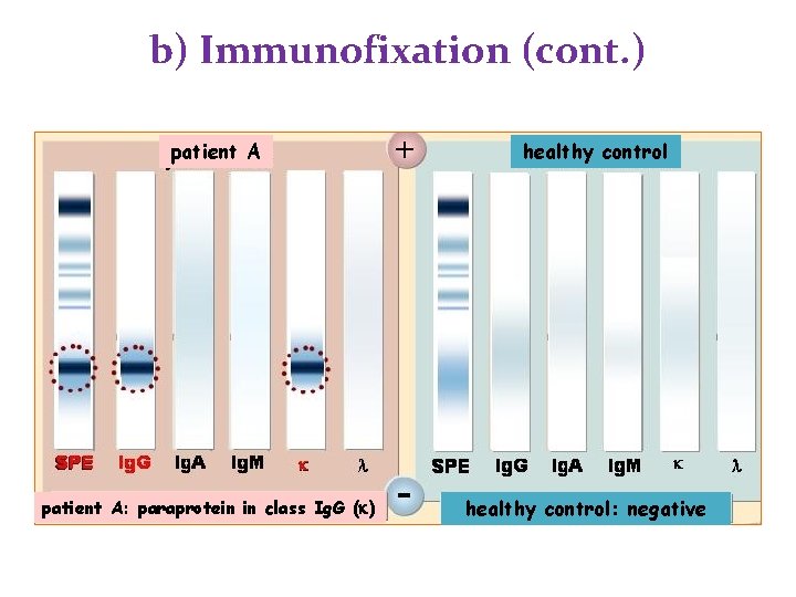b) Immunofixation (cont. ) patient A: paraprotein in class Ig. G (k) healthy control: b) Immunofixation (cont. ) patient A: paraprotein in class Ig. G (k) healthy control: