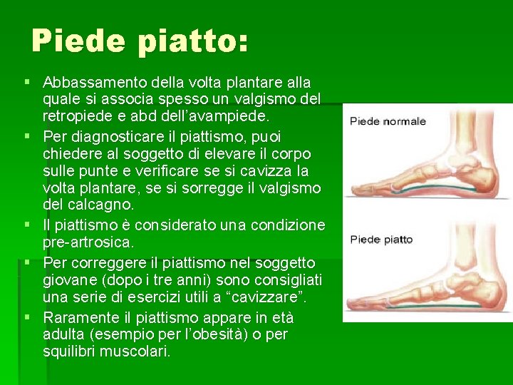 Piede piatto: § Abbassamento della volta plantare alla quale si associa spesso un valgismo