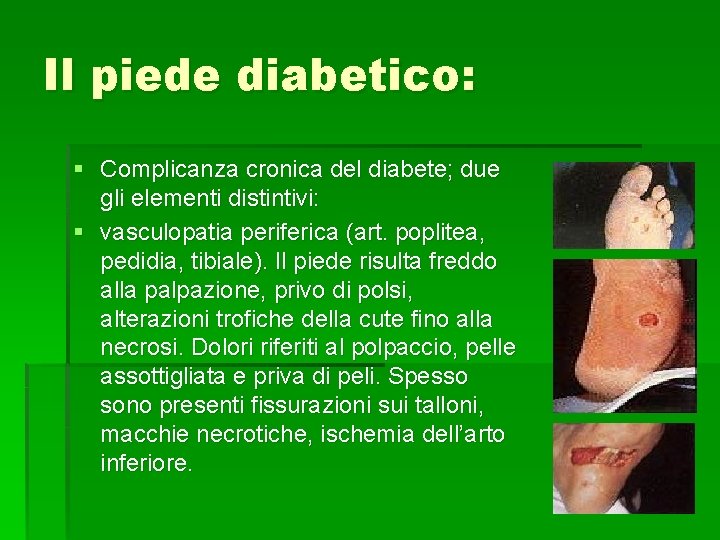 Il piede diabetico: § Complicanza cronica del diabete; due gli elementi distintivi: § vasculopatia