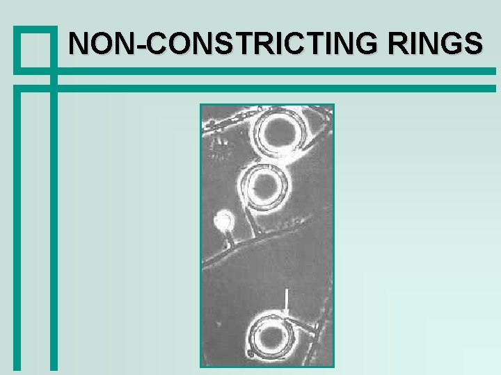 NON-CONSTRICTING RINGS 