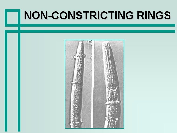 NON-CONSTRICTING RINGS 