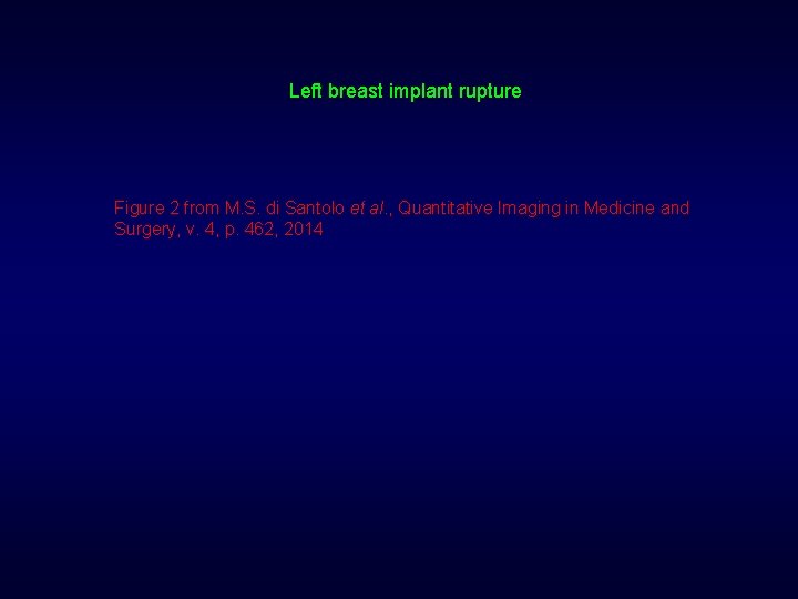 Left breast implant rupture Figure 2 from M. S. di Santolo et al. ,