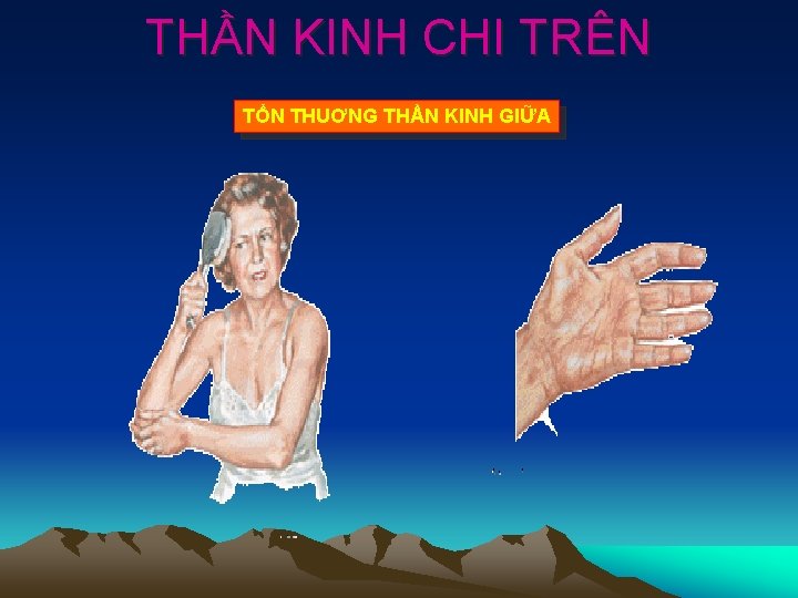 THẦN KINH CHI TRÊN TỔN THUƠNG THẦN KINH GIỮA 