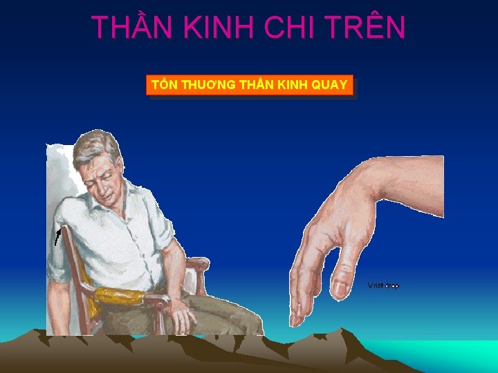 THẦN KINH CHI TRÊN TỔN THUƠNG THẦN KINH QUAY 