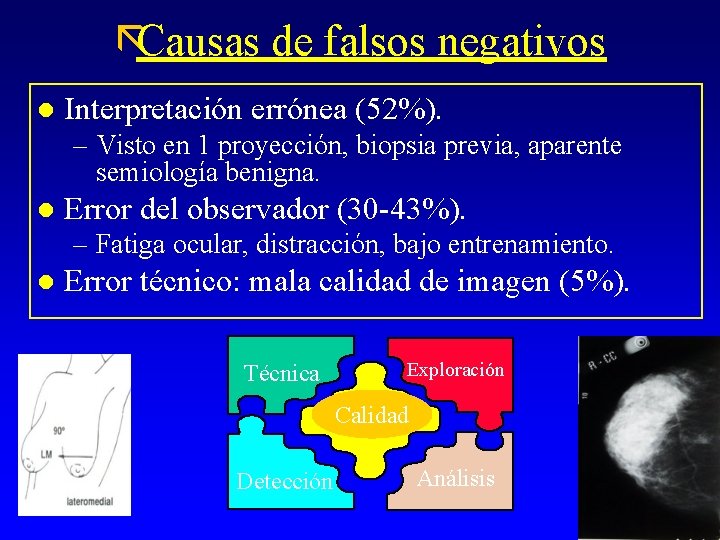 ãCausas de falsos negativos l Interpretación errónea (52%). – Visto en 1 proyección, biopsia