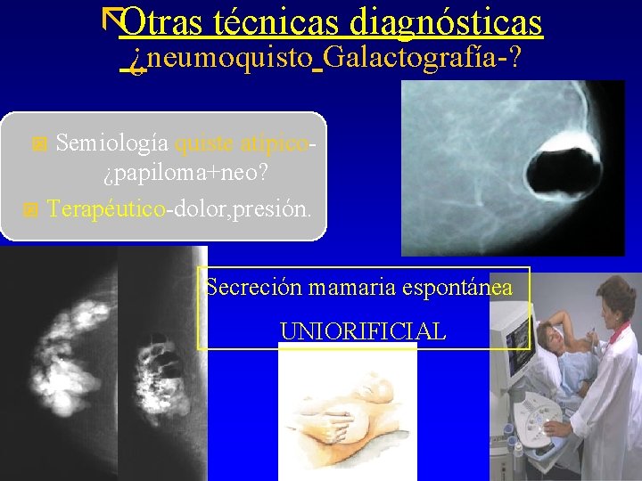 ãOtras técnicas diagnósticas ¿neumoquisto Galactografía-? Semiología quiste atípico¿papiloma+neo? ý Terapéutico-dolor, presión. ý Secreción mamaria