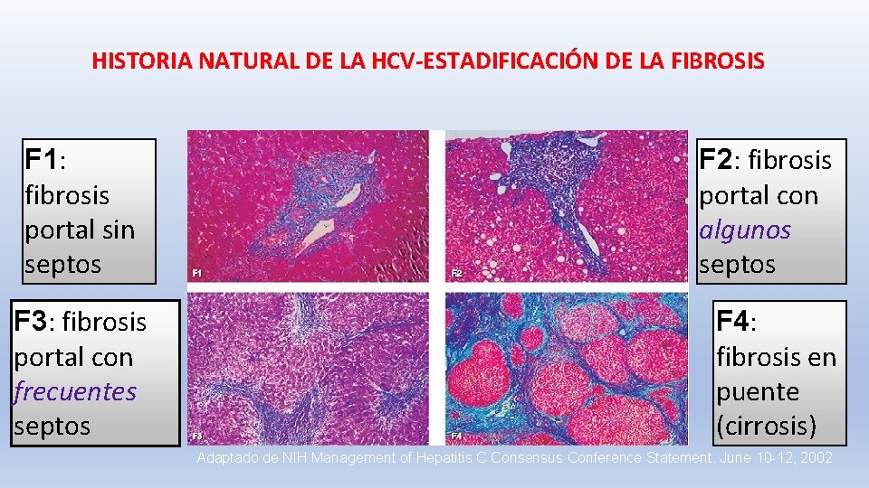 HISTORIA NATURAL DE LA HCV-ESTADIFICACIÓN DE LA FIBROSIS F 1: fibrosis portal sin septos