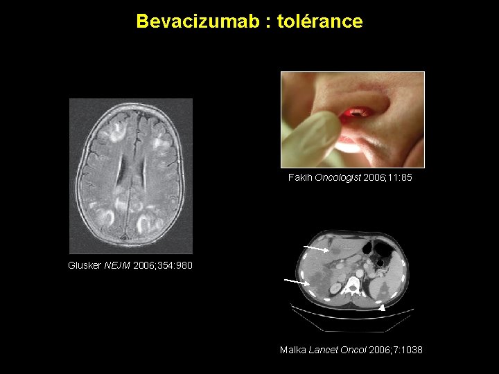 Bevacizumab : tolérance Fakih Oncologist 2006; 11: 85 Glusker NEJM 2006; 354: 980 Malka