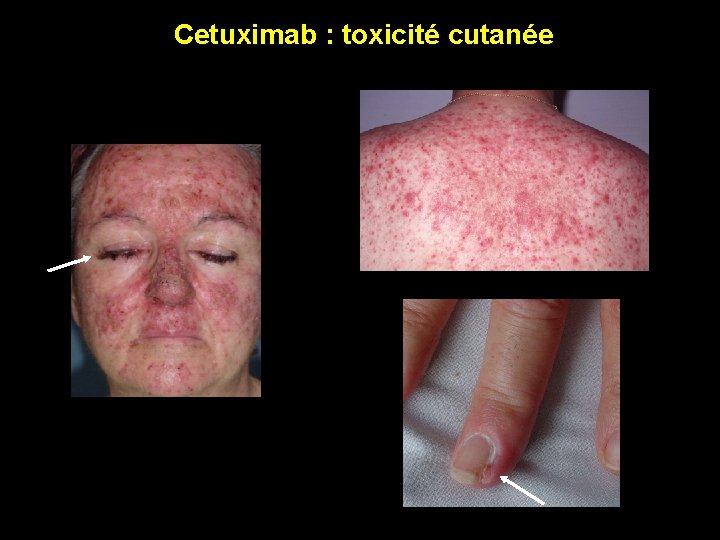 Cetuximab : toxicité cutanée 