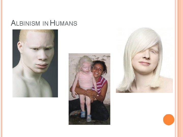 ALBINISM IN HUMANS 