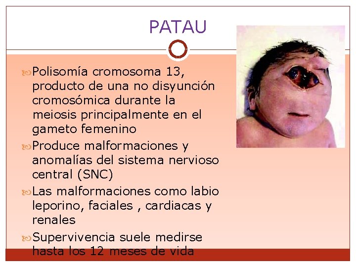 PATAU Polisomía cromosoma 13, producto de una no disyunción cromosómica durante la meiosis principalmente