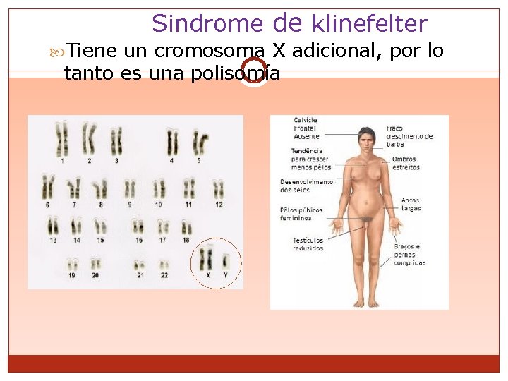 Sindrome de klinefelter Tiene un cromosoma X adicional, por lo tanto es una polisomía