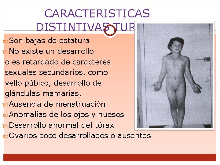 CARACTERISTICAS DISTINTIVAS TURNER Son bajas de estatura No existe un desarrollo o es retardado
