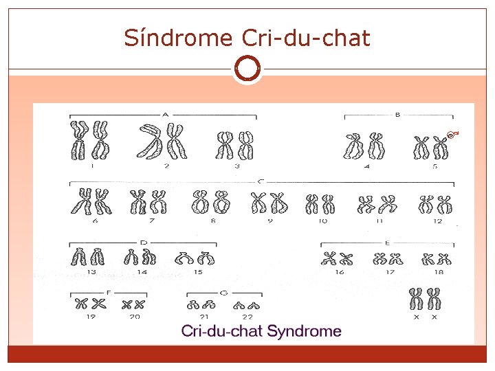 Síndrome Cri-du-chat 