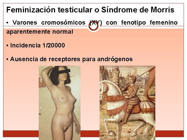 Feminización testicular o Síndrome de Morris • Varones cromosómicos (XY) con fenotipo femenino aparentemente