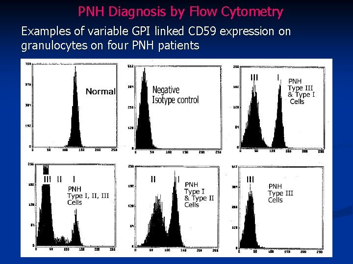 PNH Diagnosis by Flow Cytometry Examples of variable GPI linked CD 59 expression on