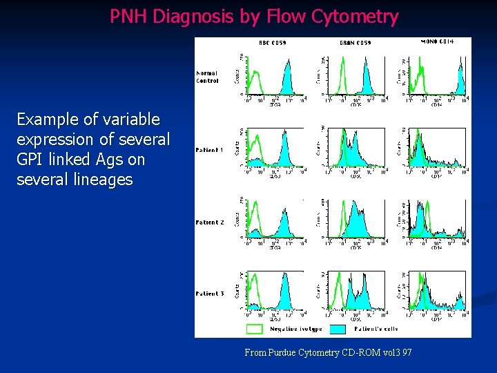 PNH Diagnosis by Flow Cytometry Example of variable expression of several GPI linked Ags